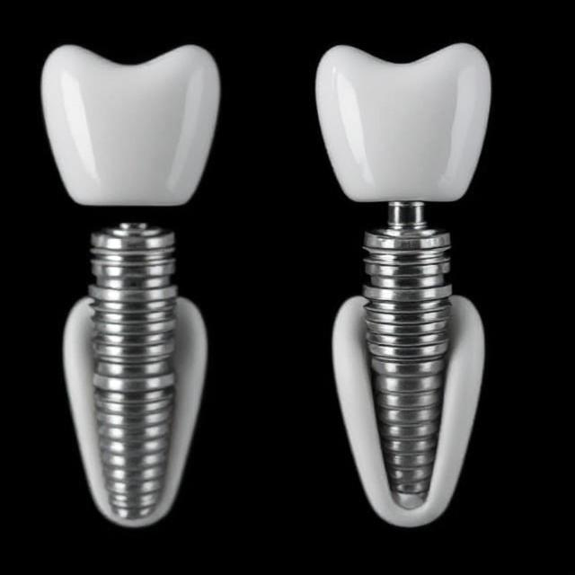 Answering Top Questions About Dental Implants After Placement